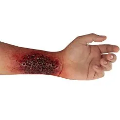 Latexwunde Trypophobie